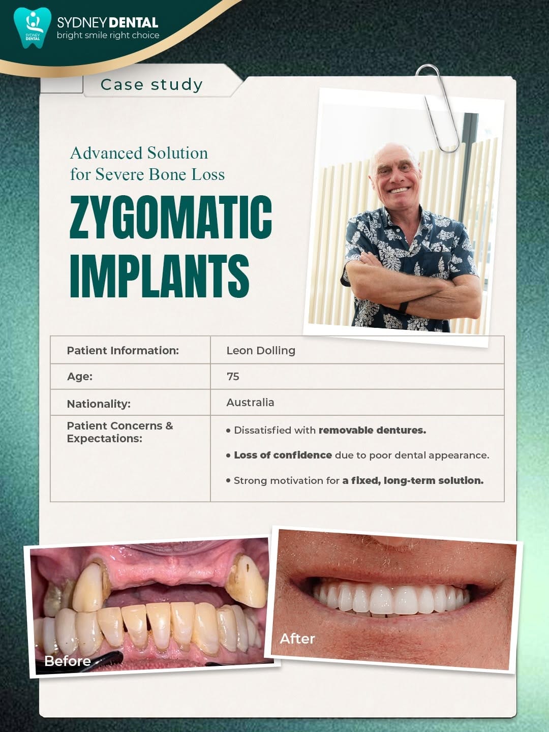 The reality of long-term denture wear: Severe bone resorption in the upper jaw, identified via advanced digital imaging.