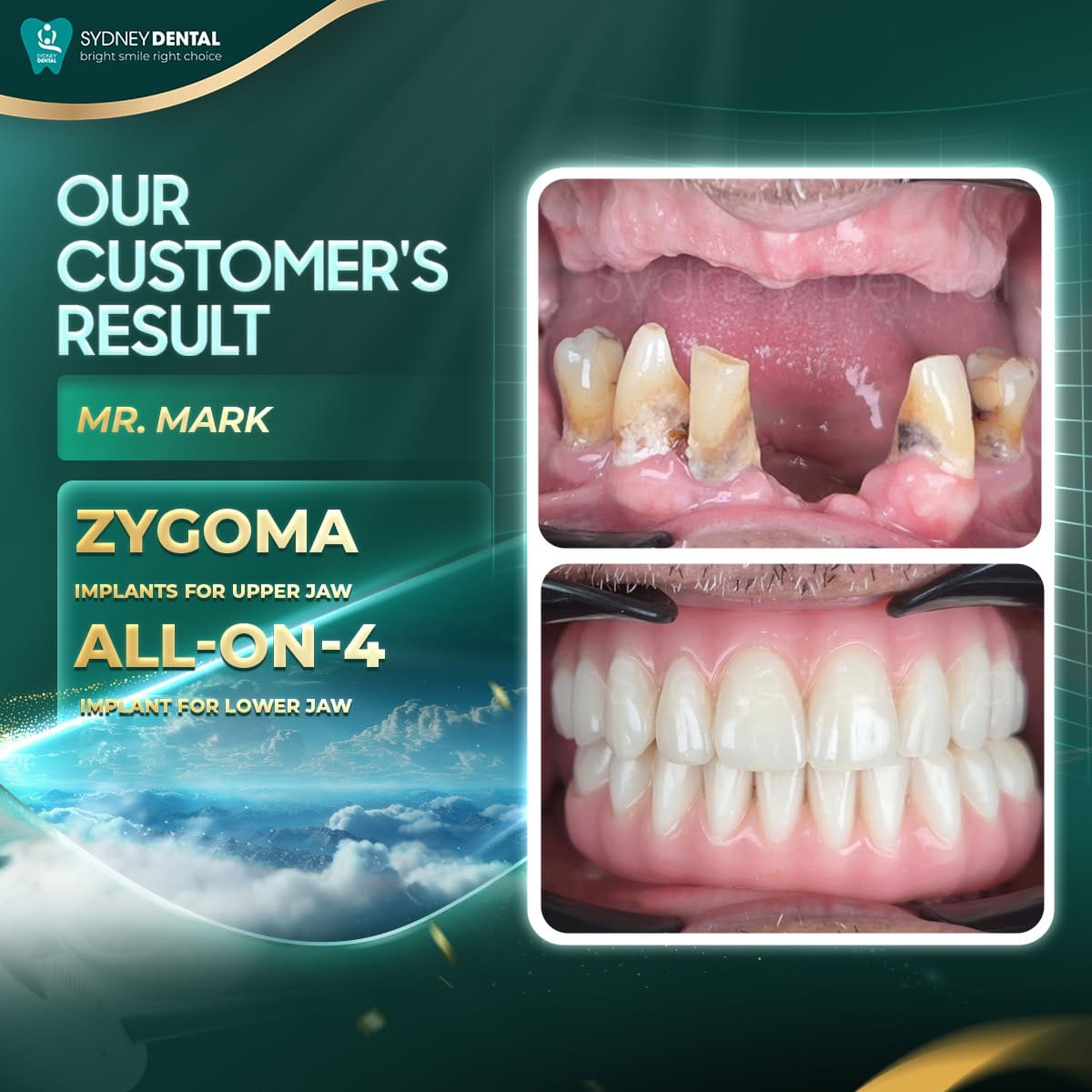 The "Boss" smile: Mark’s 14-day transformation from dental anxiety to renewed confidence and a perfect, natural-looking smile.