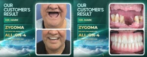 Mark - Case of the Week #7: From 30 Years of Dental Struggle to a Confident "Boss" Smile