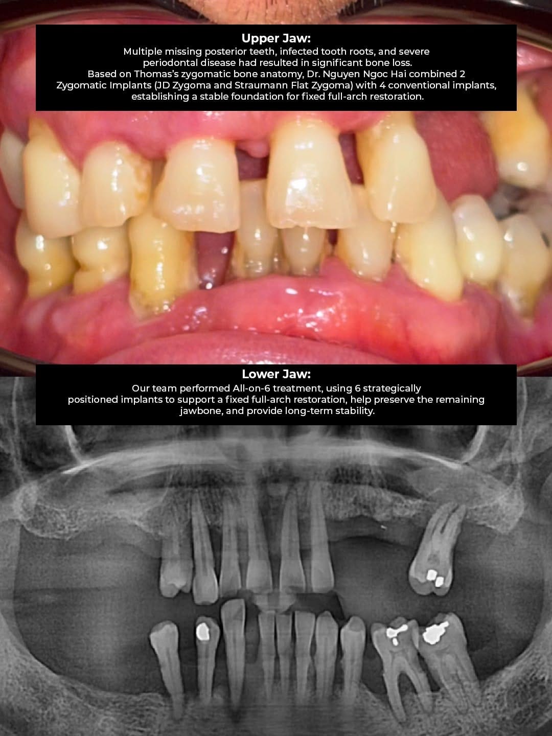 Pre-operative CBCT scan revealing significant bone atrophy in the upper jaw, presenting a complex challenge for traditional implant placement.