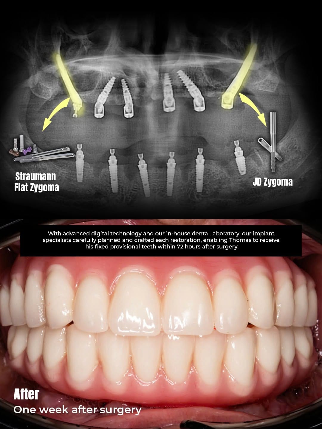 Surgical mapping demonstrating the precision placement of Zygomatic and All-on-6 implants, designed to bypass bone grafting while ensuring optimal stability.