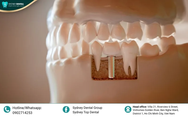 A dense jawbone acts as a solid anchor, while soft bone lacks the stability needed for a successful implant.