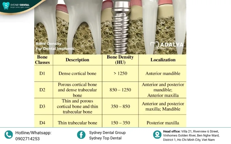 The Misch Scale: Visualizing bone density categories from D1 (highly dense) to D4 (porous/spongy).