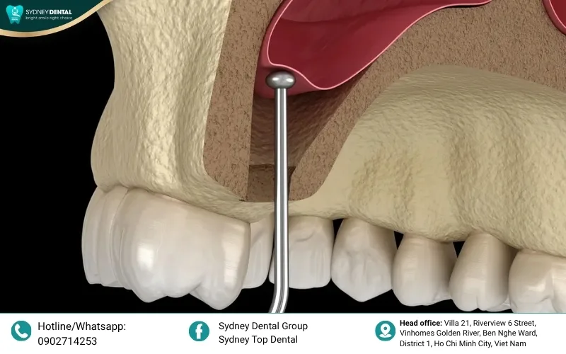 Bone grafting and Sinus lift: Reinforcing the upper jaw with bone material to create a stable foundation for successful implant placement.