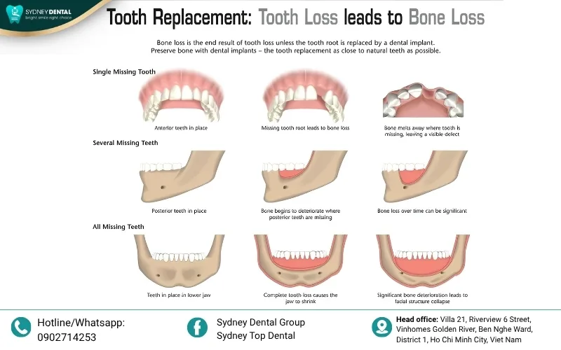 Progressive bone loss leads to the collapse of the lower face, causing premature aging and functional challenges.