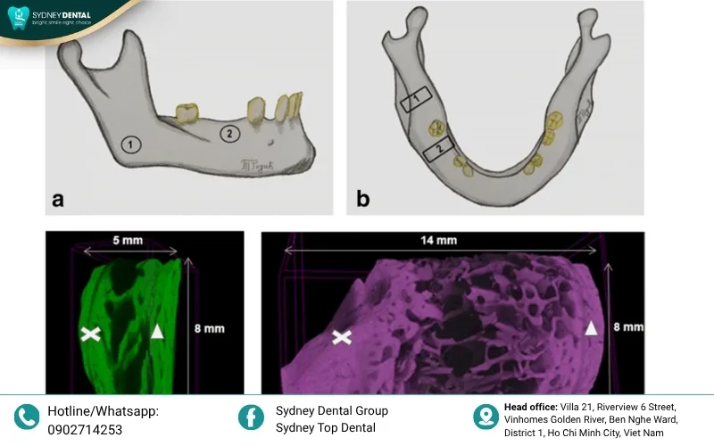 Dentures losing stability as the underlying bone shrinks.