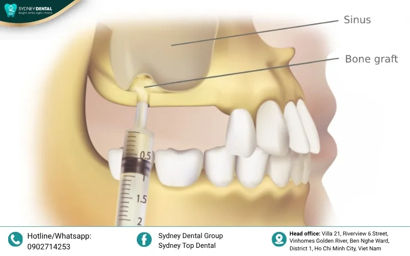 Bone grafting: Rebuilding the foundation for a permanent smile.