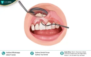 7 Dental Bone Loss Causes & Best Prevention Solutions