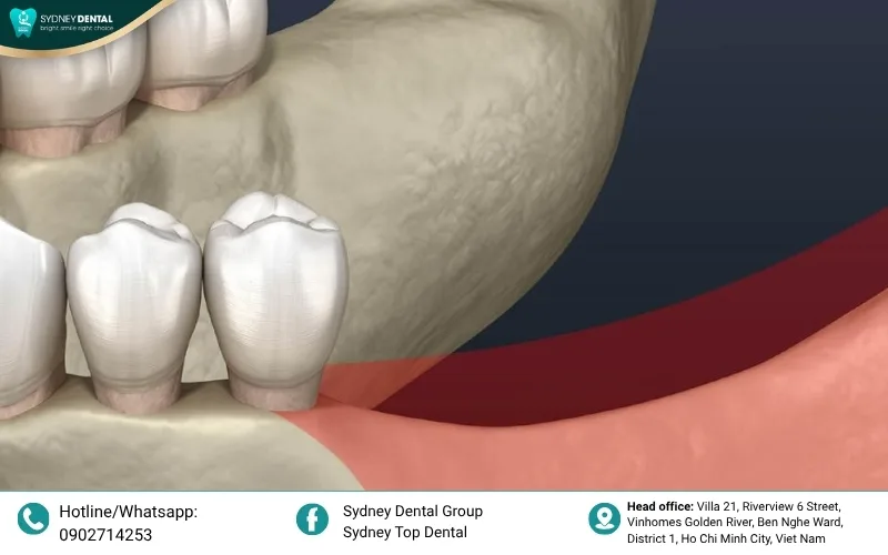 The progressive cycle of bone resorption following tooth loss, showing the shrinkage of the jawbone ridge over time.