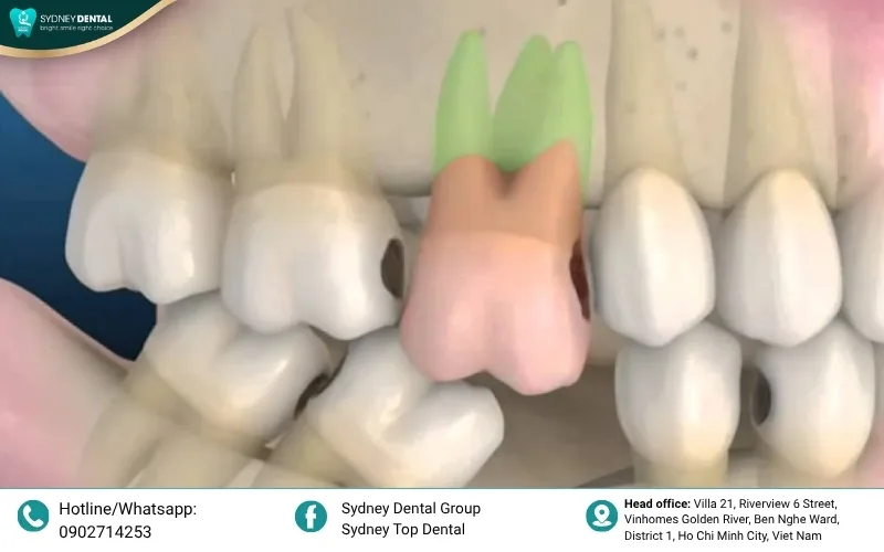 The delicate biological balance between bone-building and bone-resorbing cells that determines your jawbone health.