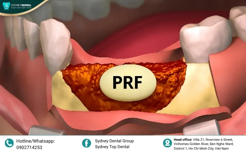 Modern medical breakthroughs like bone grafting and PRF/PRP therapy help stimulate the body's natural healing potential.