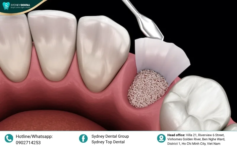 Bone grafting material placed in the extraction site to stimulate natural bone regeneration.