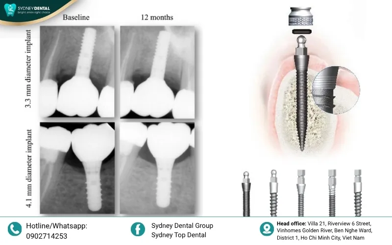 High-resolution 3D CBCT scan enabling precise planning for implant placement and bone assessment.