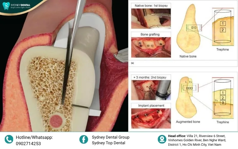 The bone grafting procedure: Rebuilding the foundation to provide a stable site for dental implant placement.