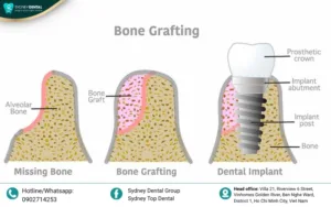 Can You Get Dental Implants When There Is Bone Loss? The 2026 Solution