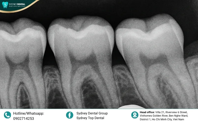 Visual comparison showing how tooth roots stimulate the jawbone versus the shrinkage that occurs after tooth loss.