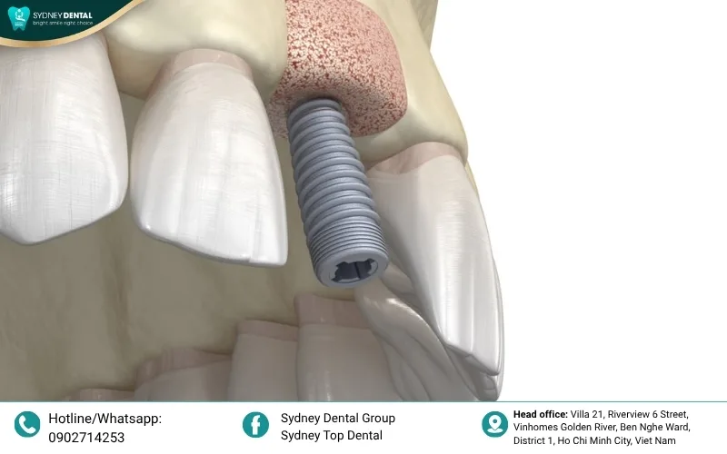 3D CT Cone Beam imaging provides a precise roadmap for safe and accurate implant placement.