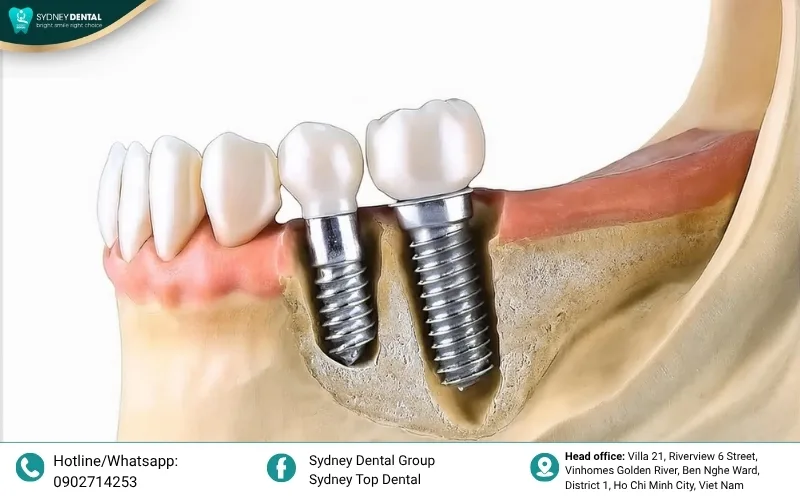 Tooth roots act as anchors that stimulate the jawbone; without this pressure, the bone naturally begins to resorb.