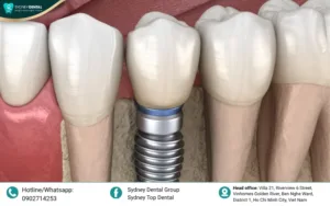Dental Implants with Severe Bone Loss: Solutions & Costs 2026