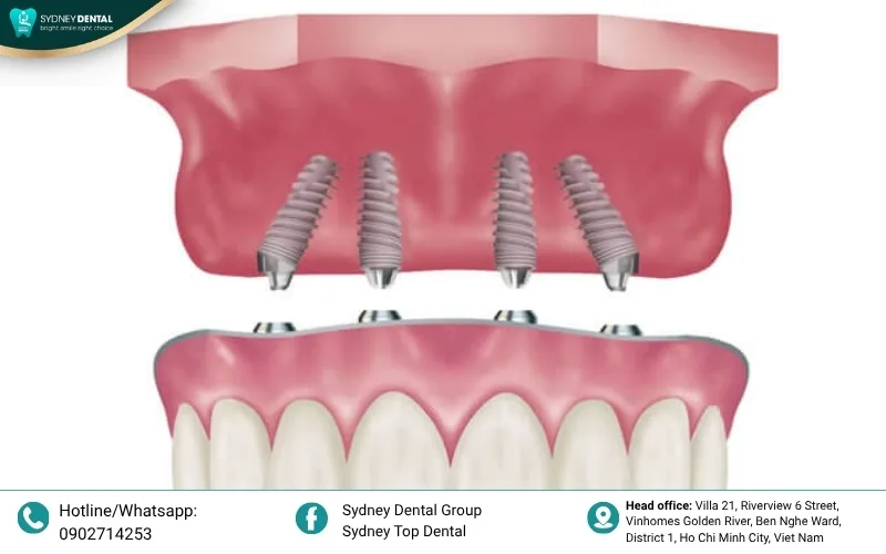 All-on-4 technique uses angled implants to secure a full-arch prosthesis, often bypassing the need for bone grafting.