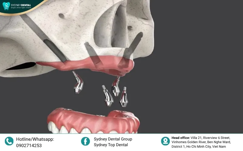 Zygoma implants are anchored into the cheekbone, providing a permanent solution for extreme cases of upper jaw atrophy.