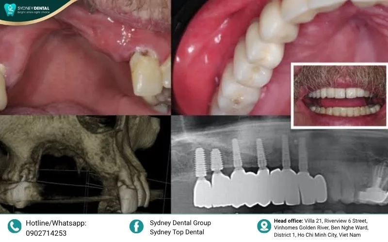 A healthy tooth root provides essential stimulation to the jawbone, whereas missing teeth lead to bone atrophy.