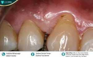 Gum Bone Loss: Signs, Causes, and Effective Treatment Solutions