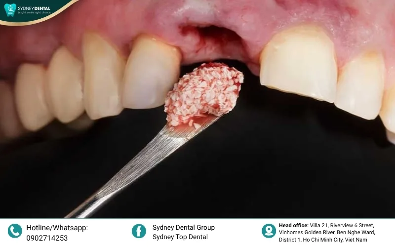 Bone grafting: Filling the bone defect with biocompatible material to stimulate new bone cell growth.