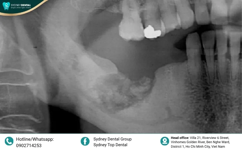 Implant stability in low-density jawbone.