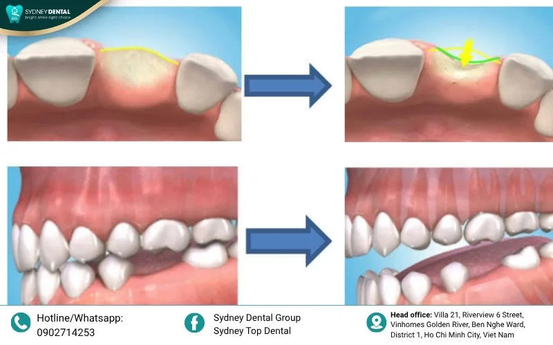 The impact of tooth loss on jawbone density.