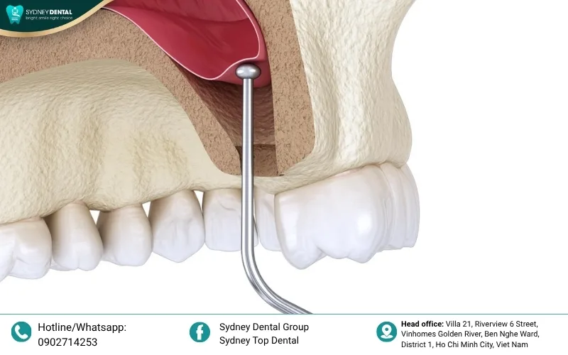 llustrating the sinus lift procedure in the upper jaw
