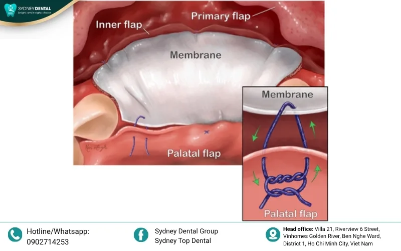 Using barrier membranes for Guided Bone Regeneration (GBR)