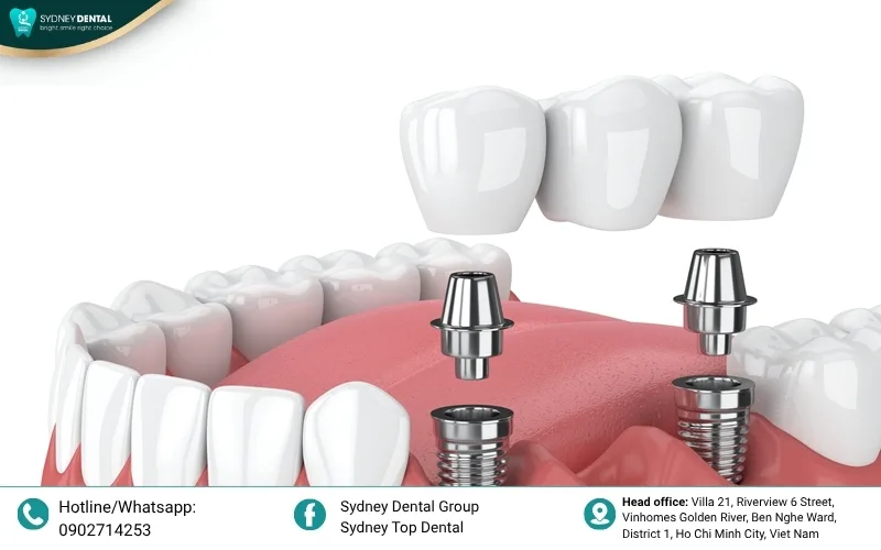 Key factors for successful long-term implant integration