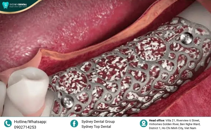 Bone loss occurs after tooth extraction due to the lack of mechanical stimulation from chewing.