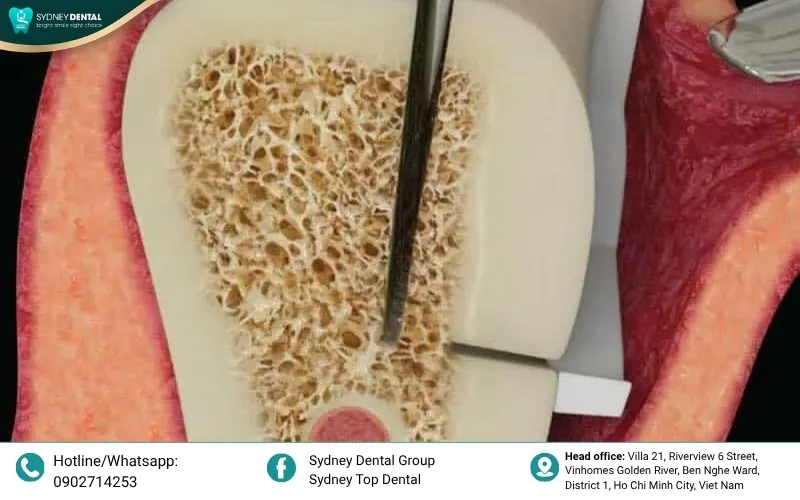 Harvesting bone from the patient’s own body provides the best biocompatibility for bone regeneration.