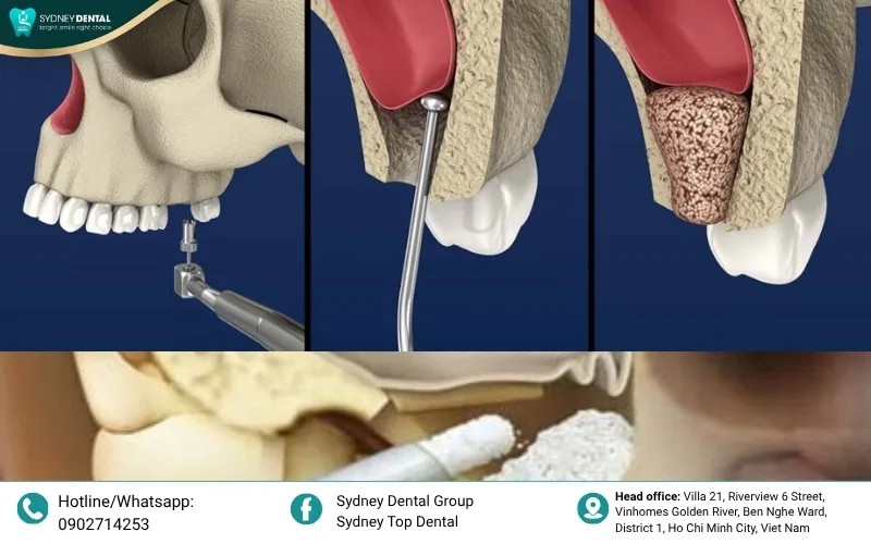 Elevating the sinus membrane to provide enough space for bone grafting in the upper jaw.