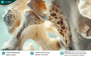 Dental Implants and Osteoporosis: Vital Tips for Success