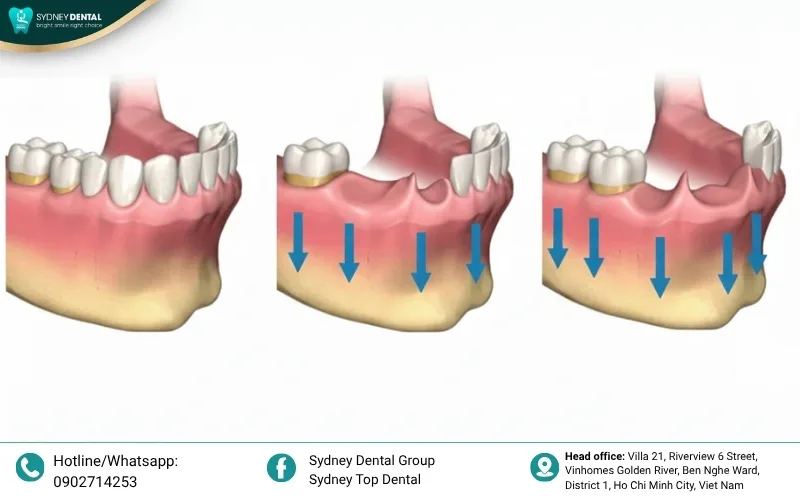 Facial profile changes: Sunken cheeks and collapsed bite resulting from severe jawbone resorption.