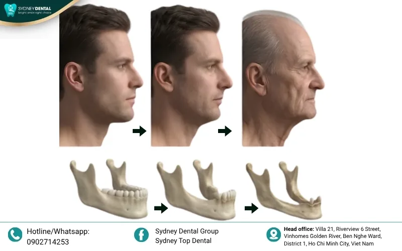 Severe jawbone loss leads to structural facial collapse and premature aging.