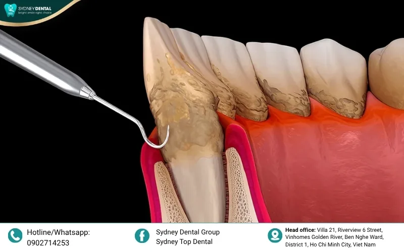 Periodontal infection causing progressive destruction of the supporting bone.
