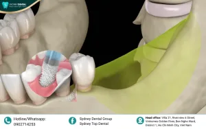 Jawbone Loss: Causes, Symptoms, and Effective Treatments