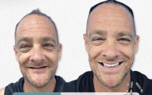 The Transformation You’ve Been Waiting For: Blair’s Journey to a New Smile