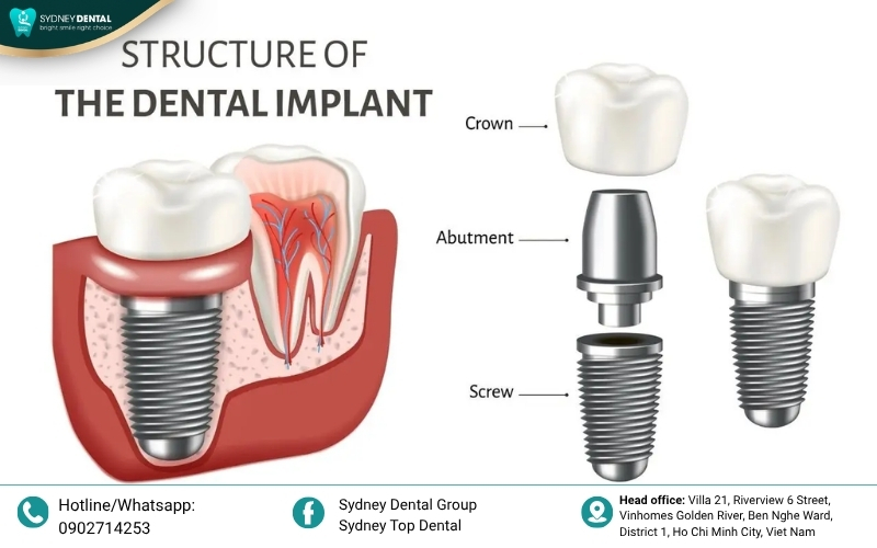 Technical breakdown of an abutment structure, showing the main body, the precision-engineered fixation screw, and the gum-level margin line.