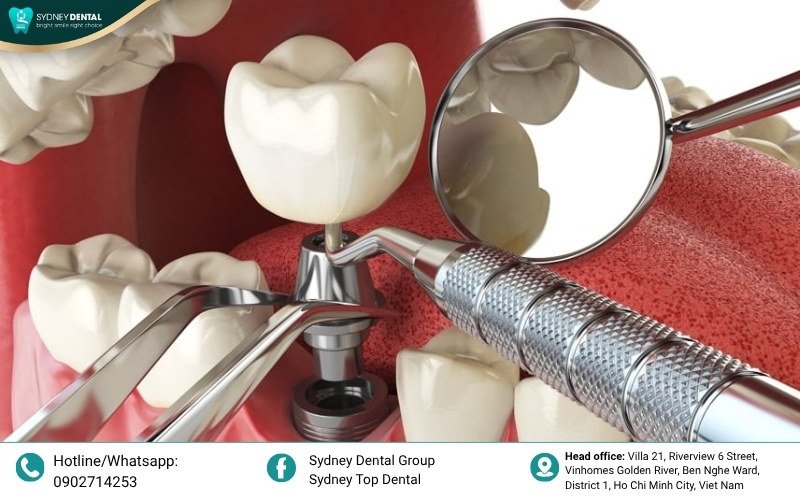 A dentist placing a temporary healing abutment onto the implant fixture to shape the surrounding soft gum tissues naturally.