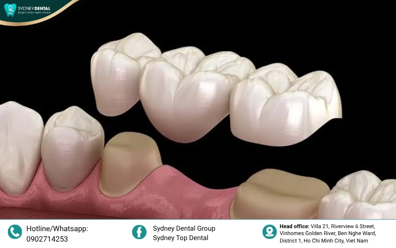 An anatomical dental model illustrating how a fixed bridge spans across a gap by anchoring securely onto adjacent natural teeth