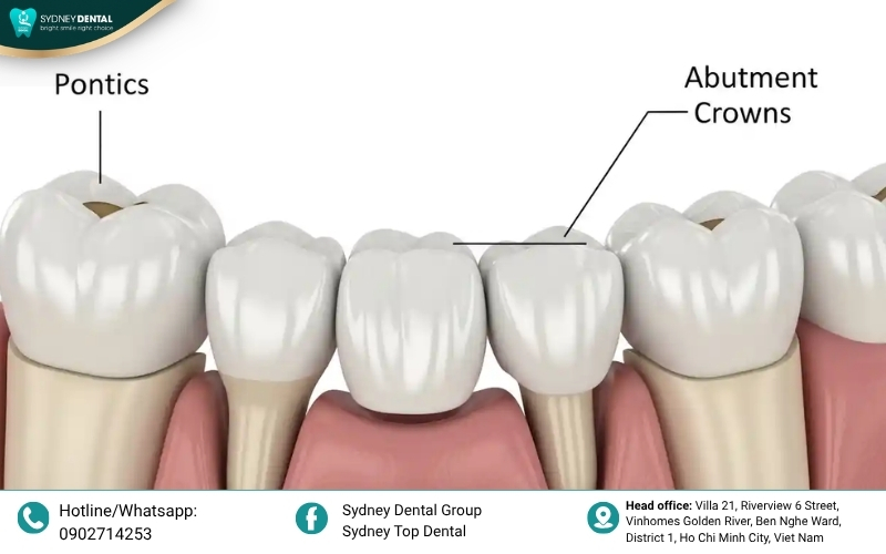 A patient happily eating and smiling, demonstrating the comfort and stability that a fixed bridge provides compared to removable dentures.