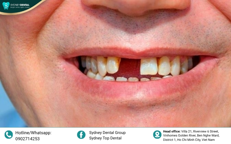 Examining their smile to determine if a fixed bridge is the ideal restorative solution.