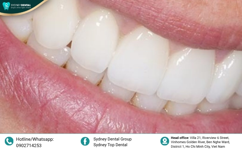 A patient demonstrating correct oral hygiene techniques, using an interdental brush and floss threader to clean underneath a fixed bridge pontic.