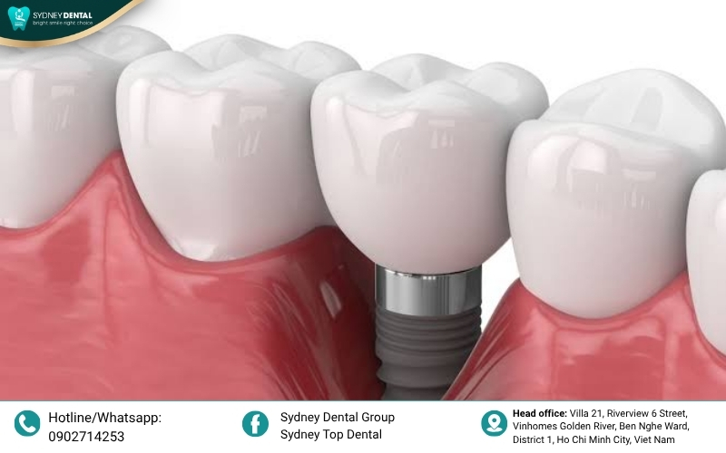 Osseointegration: The biological connection between bone and implant.