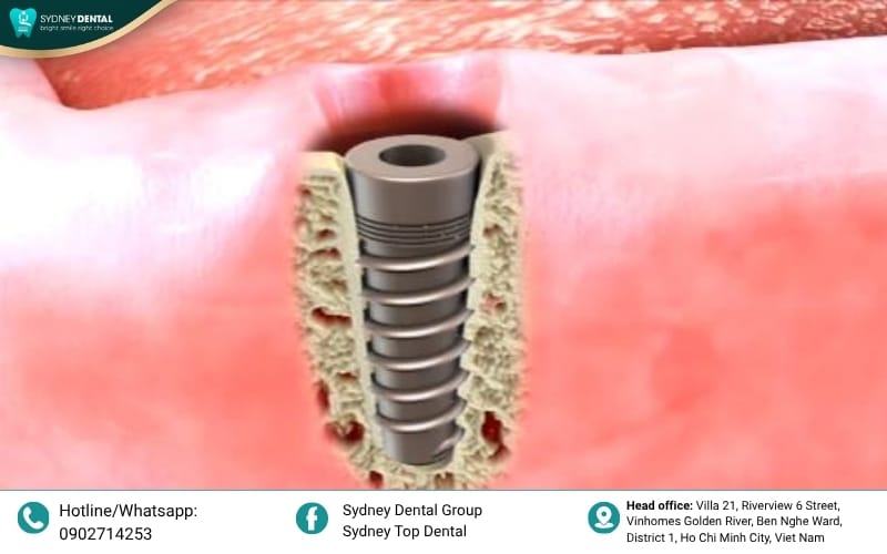 Osseointegration restores both oral function and limb mobility.